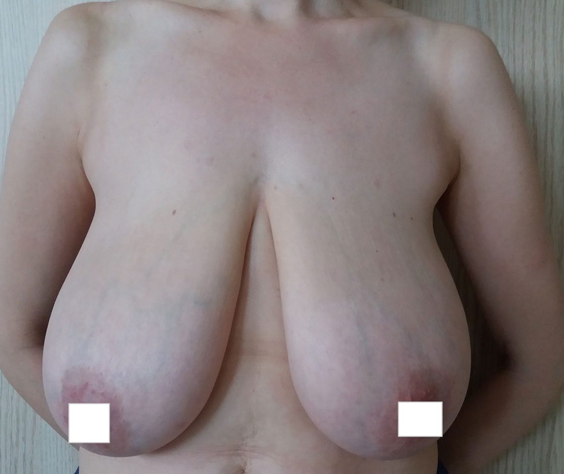 redukcja-piersi-przed-1