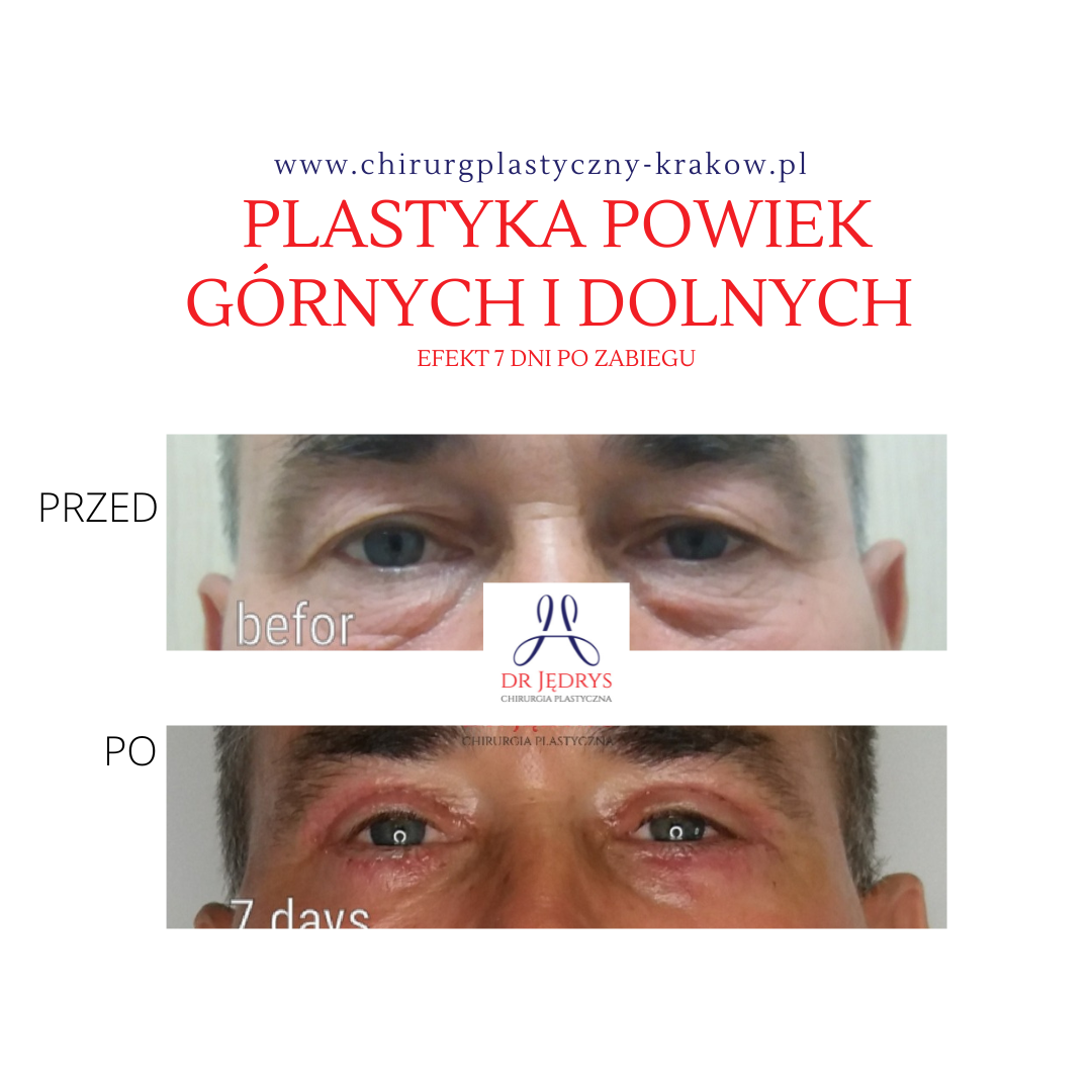 plastyka powiek górnych i dolnych dr Jędrys Kraków