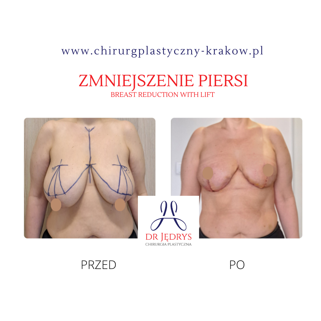 breast reduction dr.Jedrys Krakow