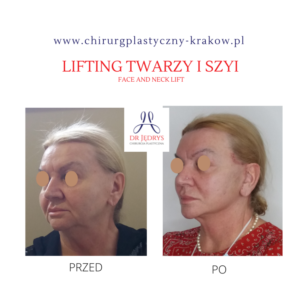 Lifting Twarzy Dr Jędrys Chirurgia Plastyczna Kraków 6858