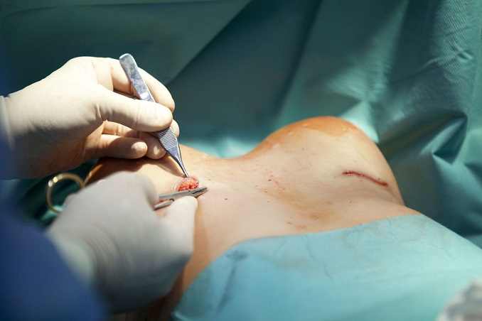 Powiększanie piersi implantami Kraków